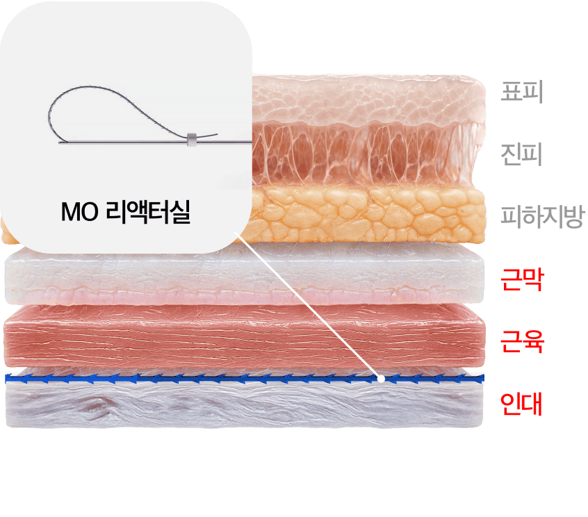 MOリアクター糸施術層の断面図
