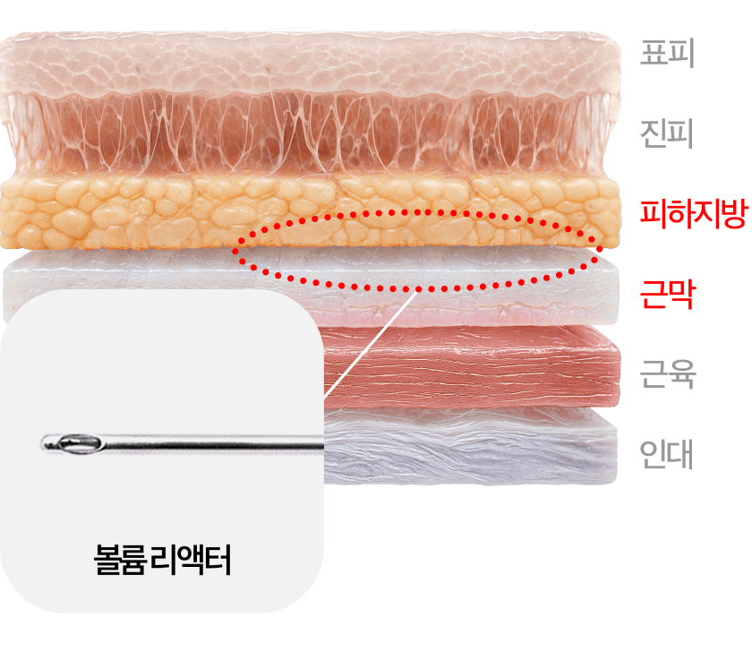 ボリュームリアクター注入層の断面図